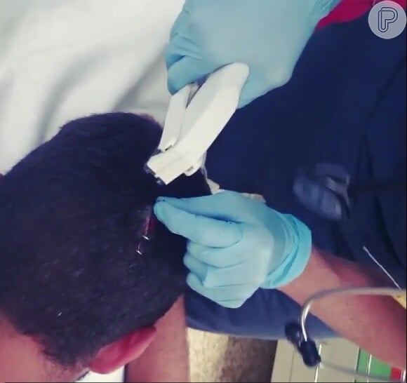 Pedro Scooby mostrou, em um vídeo no Instagram, o momento em que levava pontos na parte de trás da cabeça