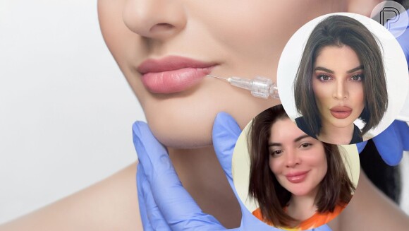 Remoção de preenchimento labial: entenda procedimento feito por Gkay para boca menos volumosa