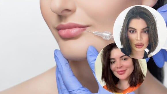 Remoção de preenchimento labial: entenda procedimento feito por Gkay para boca menos volumosa