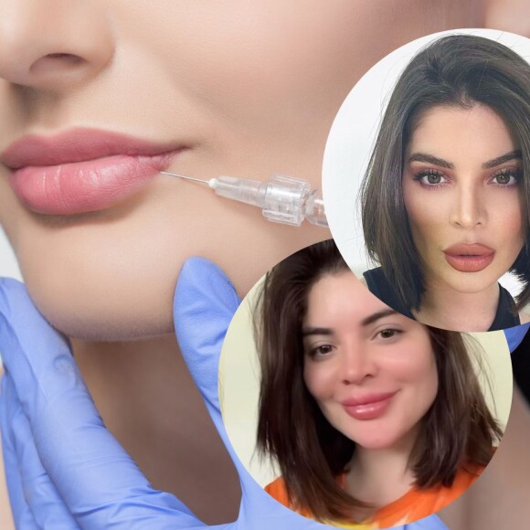 Remoção de preenchimento labial: entenda procedimento feito por Gkay para boca menos volumosa