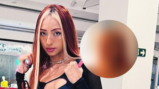 Ruivinha de Marte faz harmonização facial e se emociona com o resultado. Veja antes e depois