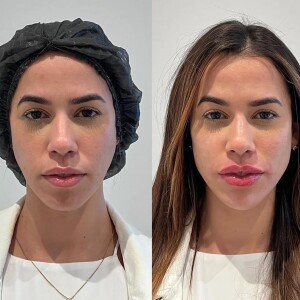 Larissa Tomásia, do 'BBB 22', surpreendeu ao surgir com rosto diferente após harmonização facial