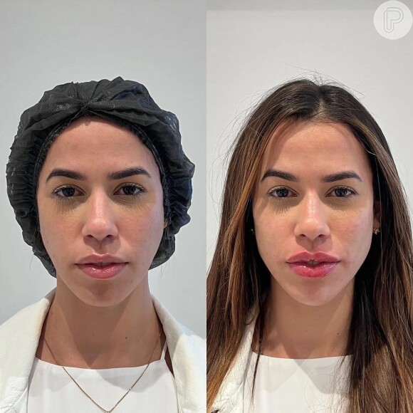 Larissa Tomásia, do 'BBB 22', surpreendeu ao surgir com rosto diferente após harmonização facial