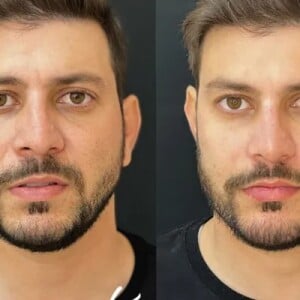 O ex-BBB Caio Afiune está na lista de 'brothers' que realizaram harmonizaçao facial
