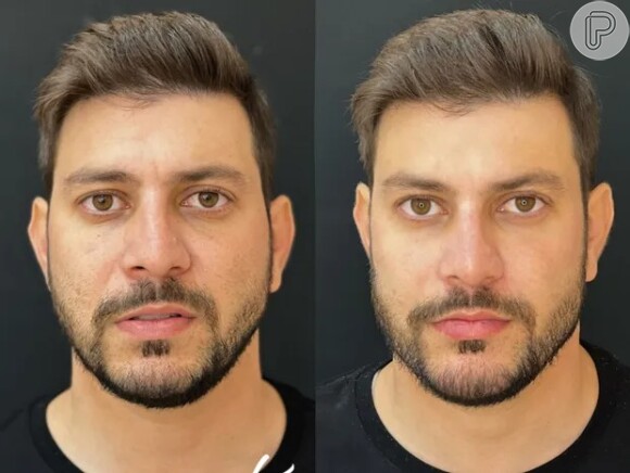 O ex-BBB Caio Afiune está na lista de 'brothers' que realizaram harmonizaçao facial