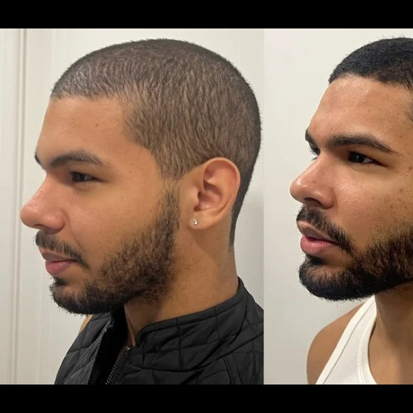 Vyni, do 'BBB 22', foi comparado com o rapper Drake após harmonização facial
