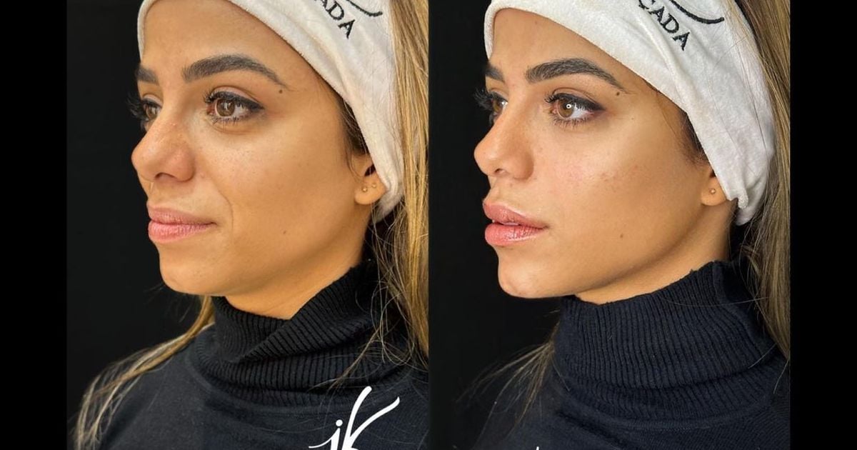 ExBBB Key Alves detalha harmonização facial 'Fiz preenchimentos com