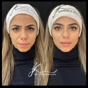 Fotos de antes e depois de harmonização facial da ex-BBB Key Alves