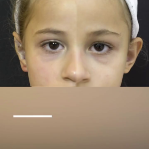 Antes e depois de Valentina Bezerra: procedimento de otomodelação é feito com anestesia local e leva cerca de 30 minutos em cada orelha