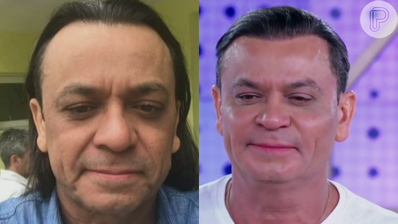 Harmonização facial de Frank Aguiar: veja antes e depois