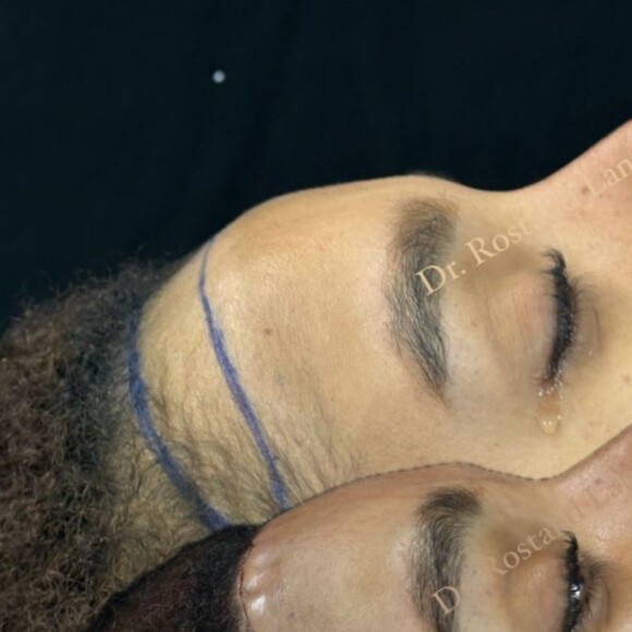 Antes e depois de Brunna Gonçalves, ainda em recuperação, gerou muitos elogios