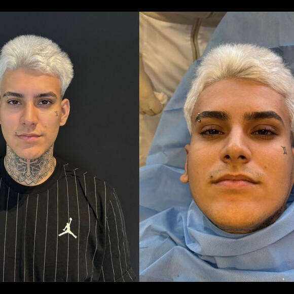 Ante e depois de Arthur Urach surpreende! Filho de Andressa Urach mostrou o resultado da cirurgia na orelha