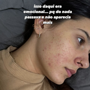 Ana Castela ainda disse acreditar que acredita que suas 'crises' de crescimento de acne tinham a ver com seu psicológico