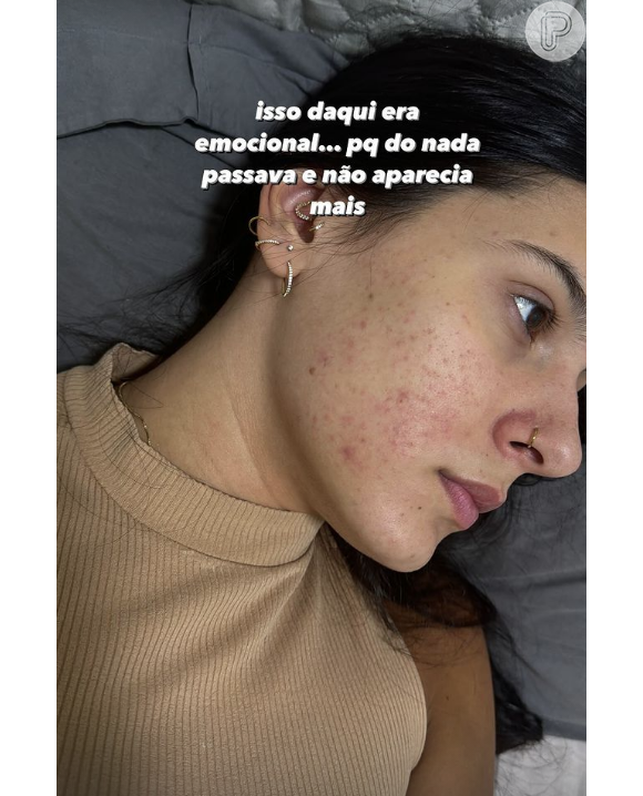Ana Castela ainda disse acreditar que acredita que suas 'crises' de crescimento de acne tinham a ver com seu psicológico