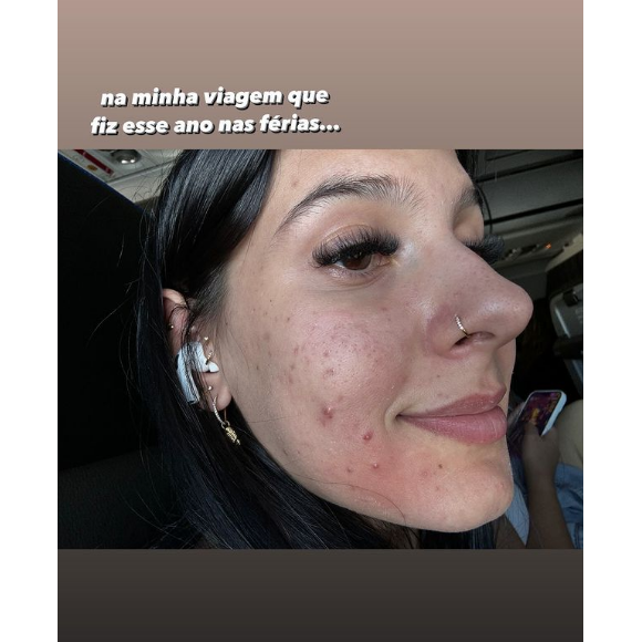 Ana Castela sofreu durante anos com o excesso de acne e enfrentou sérios problemas de autoestima