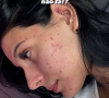 Ana Castela destacou, em uma sequência de imagens, sua pele recheada de acne nos últimos tempos