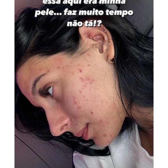 Ana Castela destacou, em uma sequência de imagens, sua pele recheada de acne nos últimos tempos