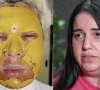 Influenciadora que fez peeling de fenol com mulher envolvida em morte chora e diz ter sido enganada: 'Disse que era biomédica'