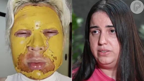 Influenciadora que fez peeling de fenol com mulher envolvida em morte chora e diz ter sido enganada: 'Disse que era biomédica'