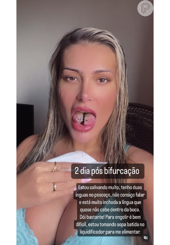 Já nesta quarta (31), Andressa Urach detalhou o processo de cicatrização da língua bifurcada