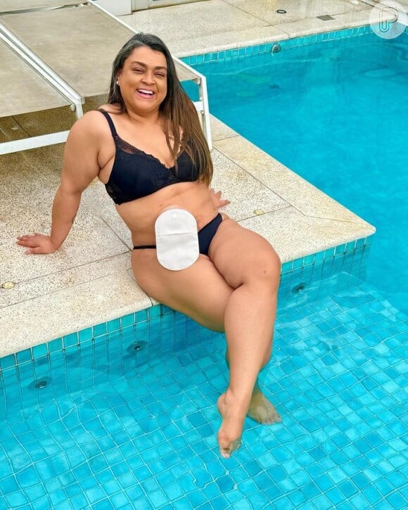 Preta Gil precisou usar uma bolsa de ileostomia durante seu tratamento