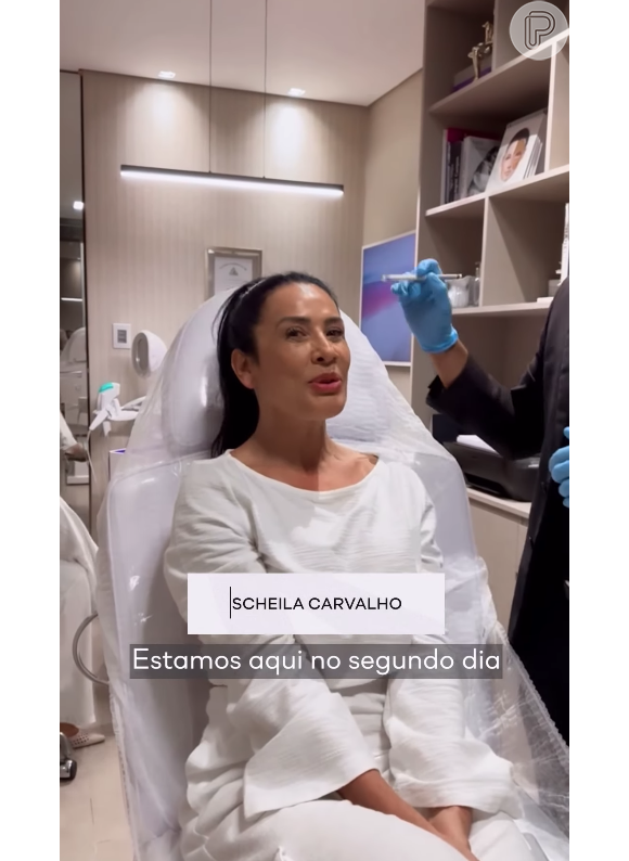 Scheila Carvalho revelou ter ficado 'chocada' com a beleza do seu rosto após a remoção do preenchimento