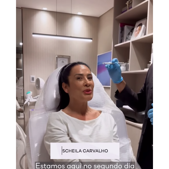 Scheila Carvalho revelou ter ficado 'chocada' com a beleza do seu rosto após a remoção do preenchimento