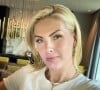 Ana Hickmann passa por procedimentos estéticos no rosto e resultado impressiona seguidores