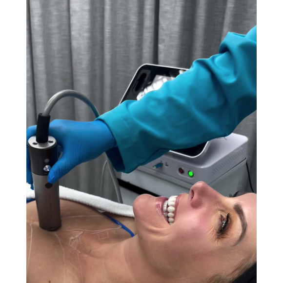 Ana Hickmann também fez o procedimento no colo, visando acabar com a flacidez da pele