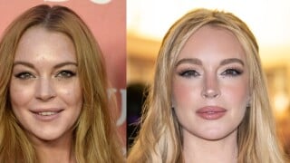 O que Lindsay Lohan fez no rosto? Transformação radical da atriz choca a web e médico explica segredo do rejuvenescimento