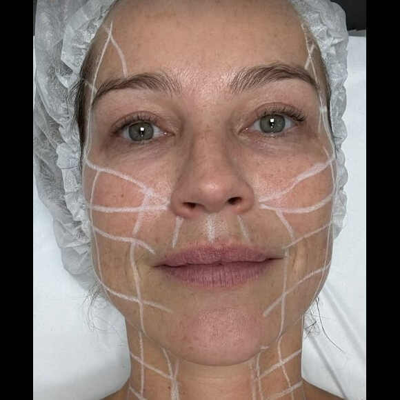 Neste sábado (23), Luana Piovani fez um procedimento estético no rosto e pescoço