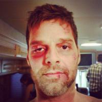 Ricky Martin publica foto com o rosto todo machucado e assusta fãs no Instagram