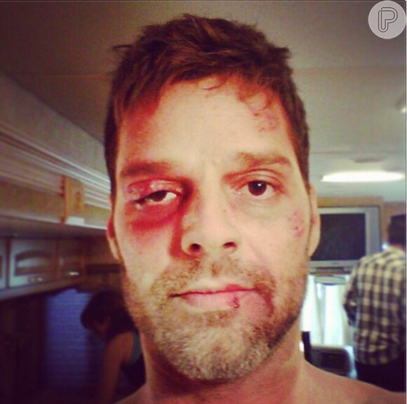 Ricky Martin assusta os fãs no Instagram como foto em que aparece com o rosto todo machucado