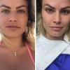 A ex-BBB Natalia Casassola se submeteu ao procedimento capaz de diminuir as bochechas e mostrou o resultado no Instagram
