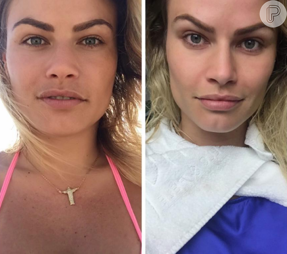 A ex-BBB Natalia Casassola se submeteu ao procedimento capaz de diminuir as bochechas e mostrou o resultado no Instagram