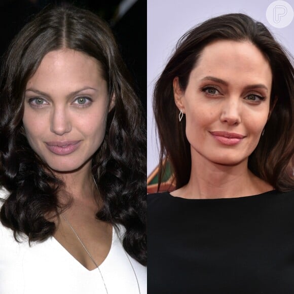 Angelina Jolie é outra famosa internacional que se submeteu ao procedimento capaz de reduzir as bochechas