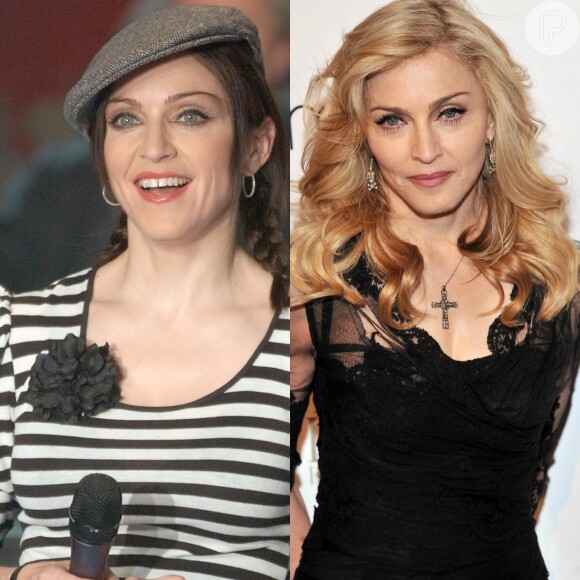 O rosto de Madonna está bem mais fino depois que ela se submeteu ao procedimento capaz de produzir este efeito