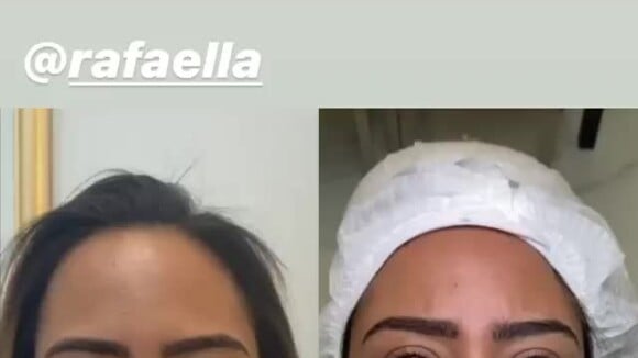 Médico mostra antes e depois do rosto de Rafaella Santos, irmã de Neymar