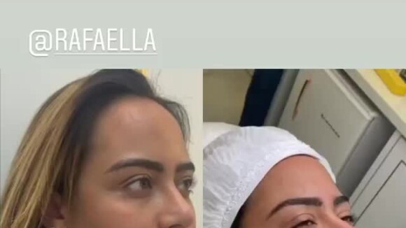 Rafaella Santos passa por remodelação facial com o médico Samuel Montalvão