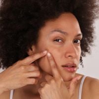 Pele com espinhas e cravos? Confira receitas caseiras para tratar a acne em casa