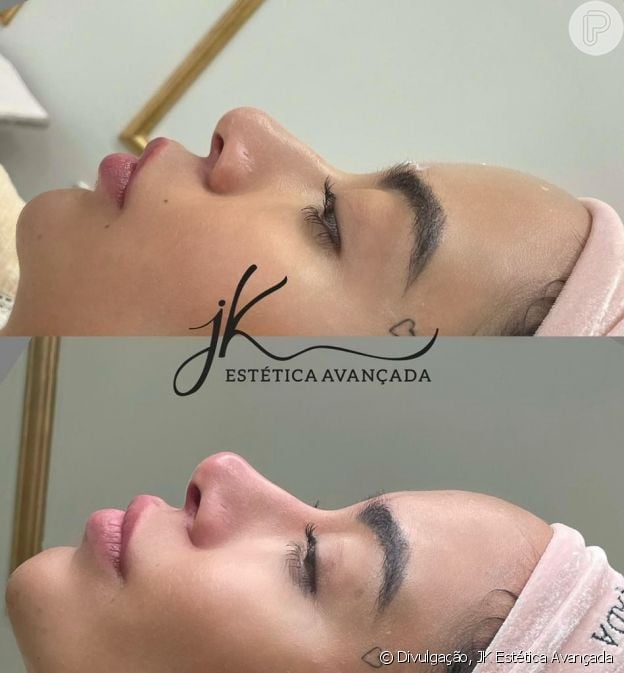 Rafaella Santos afinou e arrebitou nariz em novo retoque de harmonização facial
