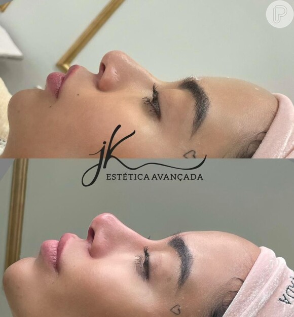 Antes e depois do rosto de Rafaella Santos, que se submeteu a um procedimento para afinar e arrebitar o nariz