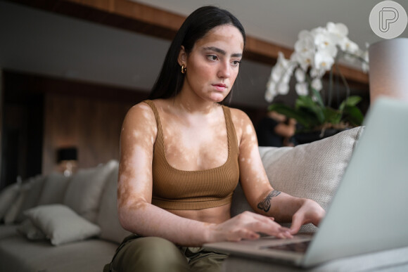 Quem tem vitiligo pode levar uma vida comum no convívio social
