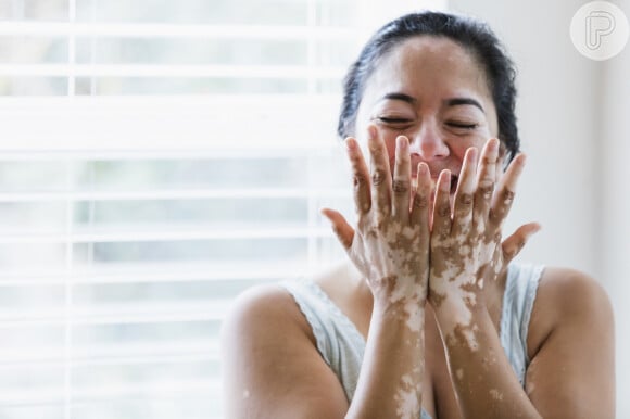 Vitiligo pode afetar pessoas de diferentes etnias e idades: a doença de pele não é contagiosa