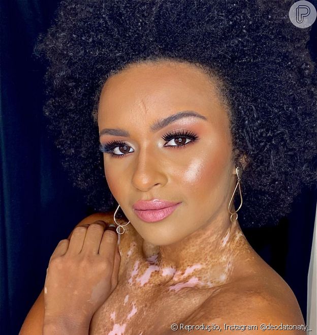 Vitiligo: a doença de pele é tratada de modo empoderado por Natália, do 'BBB 22'