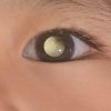 Câncer nos olhos: quais são os sintomas da doença da filha de Tiago Leifert. Principal sintoma envolve brilho branco no olho doente
