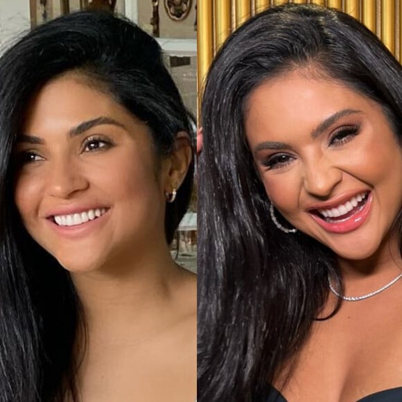 Mileide Mihaile passou por uma harmonização facial. Compare o antes e o depois!