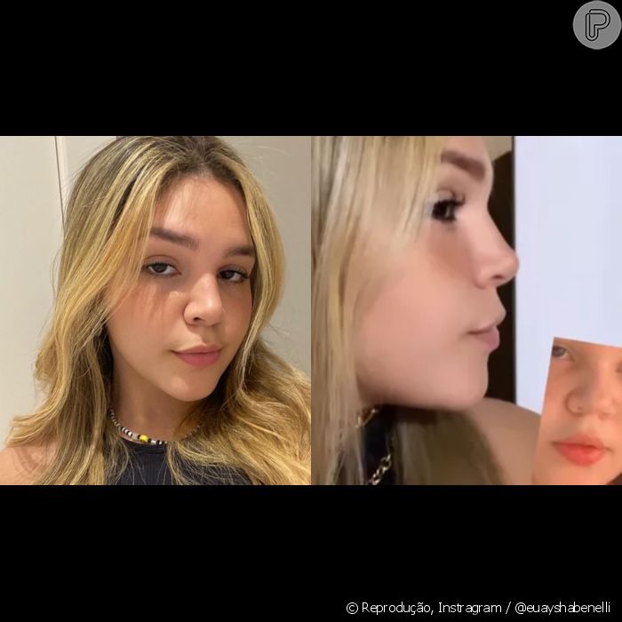 Filha de Simony, Aysha Benelli mostra antes e depois de rinoplastia e surpreende seguidores