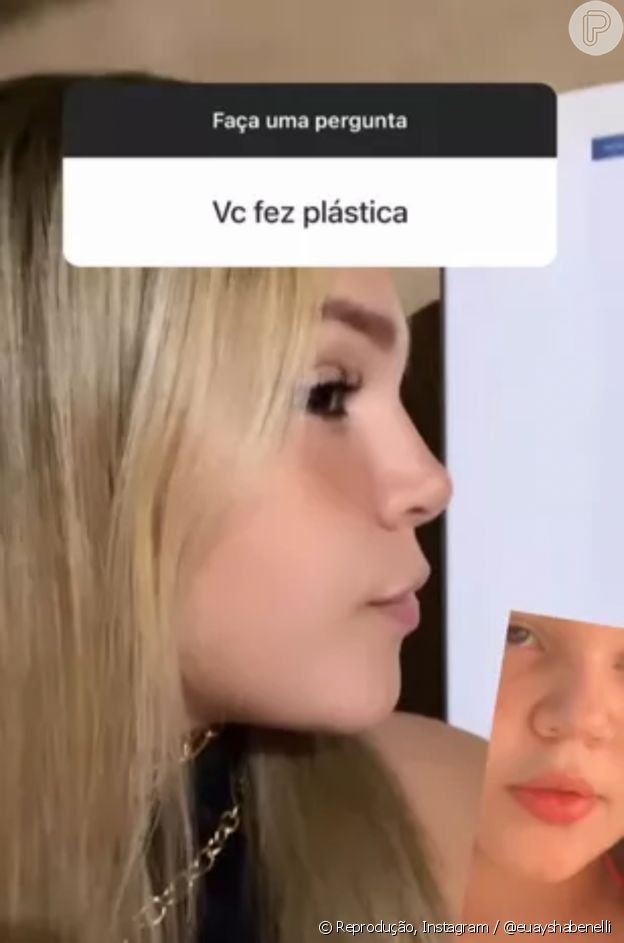 Aysha Benelli, filha de Simony, mostra antes e depois de cirurgia plástica no nariz