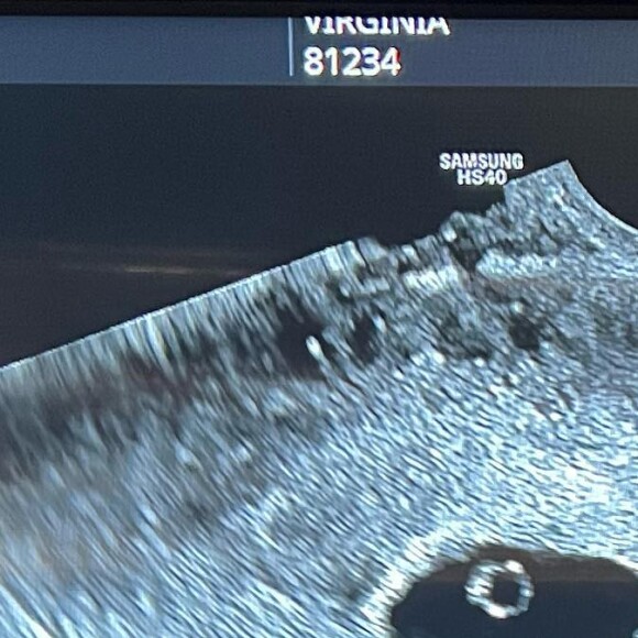 Virgínia Fonseca compartilhou o primeiro ultrassom do segundo filho